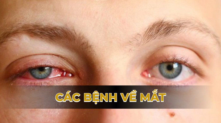 Các bệnh về mắt