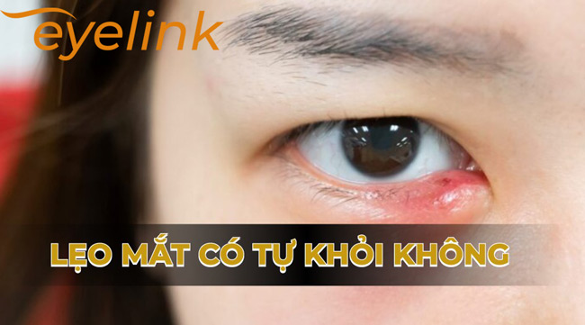 Khả năng tự khỏi của lẹo mắt