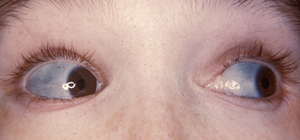 Tròng trắng mắt bị xanh là bệnh gì? Có nguy hiểm hay không?