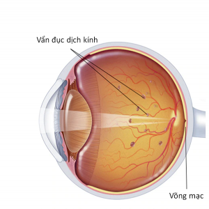 thuốc nhỏ mắt chữa đục dịch kính