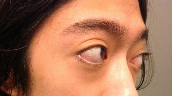Tác hại của việc mổ mắt cận thị