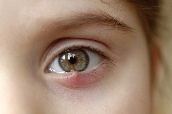 5 cách trị lẹo mắt nhanh nhất trong 1 đêm an toàn ngay tại nhà