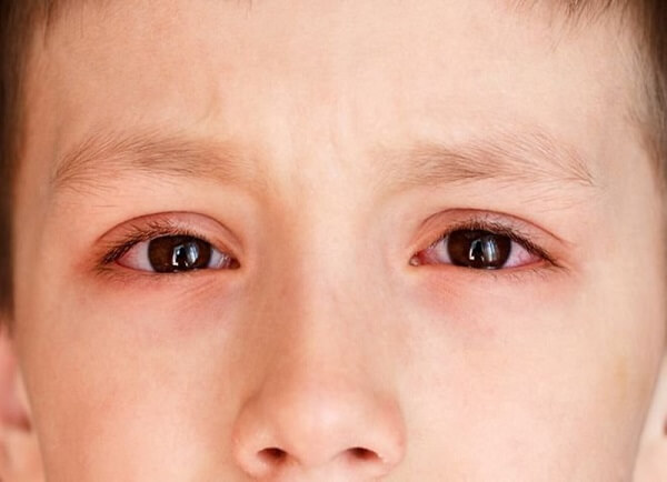 các dấu hiệu đau mắt hột